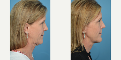 55-64 year old woman treated with Silhouette InstaLift - 56 year old female concerned with with sagging in the mid face. Silhouette Instalift procedure was performed to give patient a more youthful, refreshed appearance.