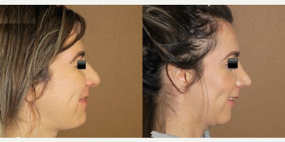 Woman treated with Rhinoplasty - Woman treated with Rhinoplasty