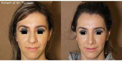 Woman treated with Rhinoplasty - Woman treated with Rhinoplasty
