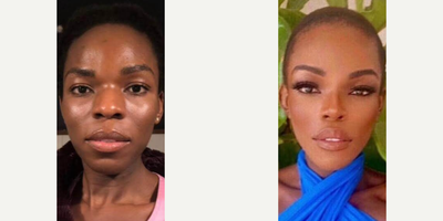 Woman treated with Genioplasty - Woman treated with Genioplasty