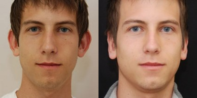 Man treated with Ear Surgery - Ear Surgery