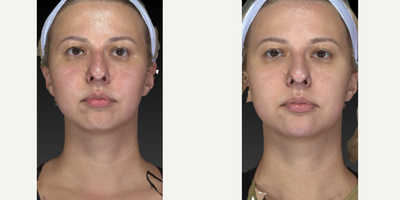 25-34 year old woman treated with Restylane Lyft - This young pretty girl came in for some chin and jawline sculpting. Dr. Caughlin is becoming known for these procedures. Pay attention to the angle of the jaw and chin projection.
