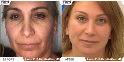 55-64 year old woman treated with Deep Plane Facelift, Rhinoplasty - .