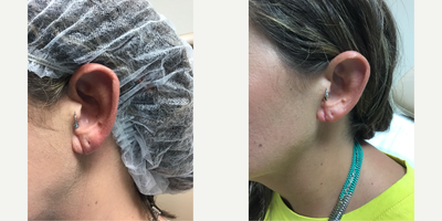 35-44 year old woman treated with Earlobe Repair - 41-year-old woman with earlobe repair