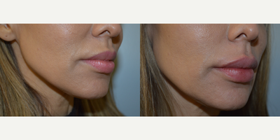 35-44 year old woman treated with Lip Augmentation - 44 year old female lip augmentation with Restylane Kysse to give subtle volume enhancement and improved contour of lips. After photo is immediately following treatment.
