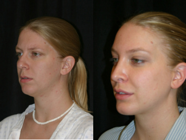 Chin Implant - Chin Implant