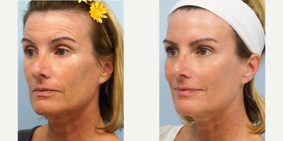 45-54 year old woman treated with Voluma - Voluma to malar cheek is achieved by placing the filler right on the cheekbone and highlighting this region giving it a more harmonized facial contour. Botox was also injected around the eyes and forehead.