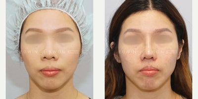 25-34 year old woman treated with Asian Rhinoplasty, DCF Rhinoplasty (2 Mo. Update) - 25-34 year-old woman treated with DCF rhinoplasty and alar base reduction. The patient was concerned that her nose looked very flat and the nasal tip appeared very bulbous. She had very thick skin, especially in her nasal tip and felt that her nose appeared overly rotated with too much nostril show. The nasal bridge was slightly augmented with a DCF graft. She required significant soft tissue debulking in her nasal tip with increased nasal tip projection and derotation to address the short nose appearance. Her nasal tip was further refined with nasal tip grafts to offset the thick skin of her nose. The alar base width was also reduced to provide an overall narrower appearing nose with less flaring of the nostrils.