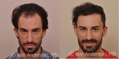 34 yo man - ARTAS Robotic Hair Transplant Surgery with PRP and ACell - 8 month post op pics - Norwood 3 Age: 34 Clinical History: Patients initial consultation with me was back in February of 2015 at the age of 33. Patient told me at our initial consultation that his hair loss made him look older than he felt on the inside. Clinical Decision Making: Patient is 33 years old, making preventive therapy more important than if he was, say, 63, as he has many more years of life to enjoy, and years of hair loss to manage than a 63 year old. We spent a significant amount of time discussing the importance of preventive therapy in a man his age, and discussed Propecia, Rogaine, platelet-rich plasma with ACell (PRP with ACell) therapy, as well as low level laser therapy (LLLT). He elected to start the following preventive therapy: 1) Propecia 1mg tabs. One tab per mouth once per day. 2) Laser Cap LLLT Therapy: Wear cap 3 times a week for 30 minutes per session. He also elected to proceed with an FUE procedure with me, using the ARTAS Robotic Hair Transplant System. We reviewed the need to trim his hair for the procedure, as well what would be accomplished on the pre-operative day, as well as how his surgery day would go. He was given pre-operative instructions and all of his questions were answered in full. Surgical Intervention: Patient had one single ARTAS Robotic Hair Transplant Procedure in May of 2015. We completed his hair restoration with 1,655 grafts to the following areas: frontal forelock, frontal hairline, and bilateral temporal recessions. In addition to the ARTAS procedure, he also had a platelet-rich plasma (PRP) with ACell treatment, as well as micro-needling to a depth of 1mm in the recipient area using some of his platelet-poor plasma (PPP) at the time of procedure. The remainder of his PPP was used on the implanted grafts following the procedure. I feel the benefits of a platelet-rich plasma (PRP) with ACell treatment in conjunction with a hair restoration procedure are so positive for the wound healing that I dont operate without using PRP unless a patient specifically declines. Results: These pictures were taken 37 weeks (about 8 months) following his ARTAS FUE procedure in February of 2016. He will continue the preventive therapy of Propecia and low level laser therapy (LLLT) with a Laser Cap brand LLLT device to limit future hair loss.