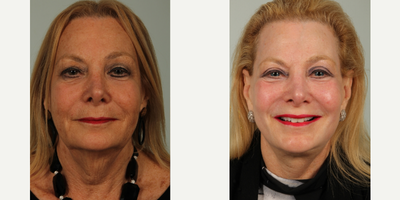 65-74 year old woman treated with Facelift, Co2 Laser Resurfacing and Upper Lid Blepharoplasty - Facelift, Co2 Laser Resurfacing and Upper Lid Blepharoplasty