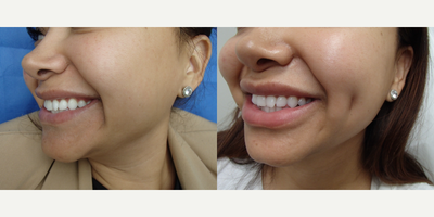 25-34 year old woman treated with Dimple Surgery - Timeless Dimple - Dimple Creation