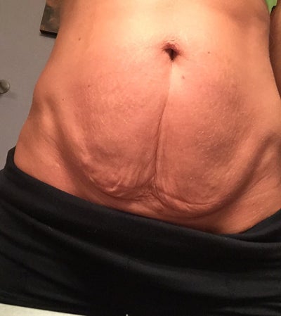 Doctor do i need a beast surgery 4