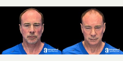 55-64 year old man treated with Dysport - The patient is a 59-year-old male with concerns about facial fine lines and wrinkles. Dr. Chiang used wrinkle relaxer (Dysport) to treat the forehead, glabella, crow's feet, under-eyes, and upper lip to address these concerns. The after results are 6 weeks post-treatment.