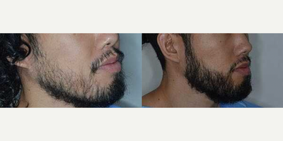 Man treated with Beard Transplant - Before and 1 year after 1800 FUE grafts to the beard
