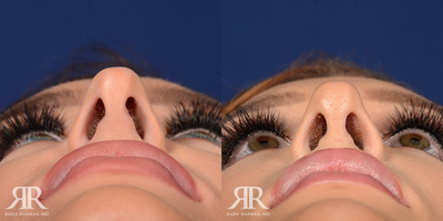 Rhinoplasty - Rhinoplasty