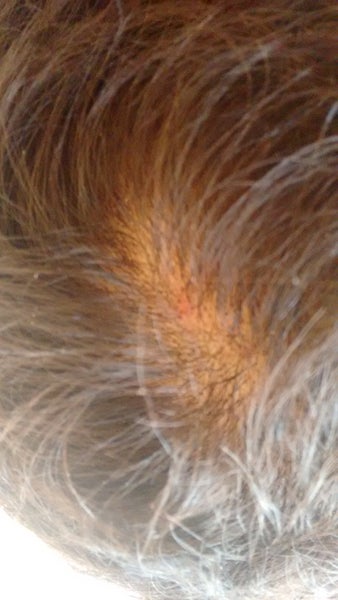 Could Somebody Please Help Diagnose My Itchy, Red, Inflamed Scalp With 