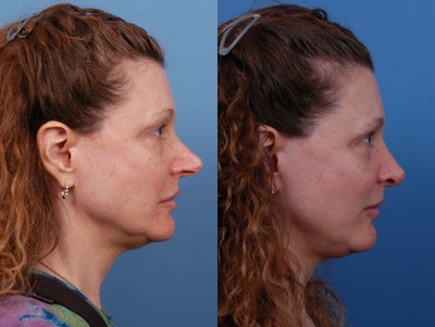Rhinoplasty Before and After - The first patient is an example of someone with the over-projected tip appearance. 