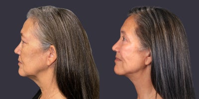 55-64 year old woman treated with Chemical Peel, Eyelid Surgery, Facelift, Lower Facelift, Neck Lift, TCA Peel, Velashape - 63 year old woman who is 5'3 tall and weighs 153 pounds. She had an upper eyelid lift, TCA chemical peel around the eyes, and a lower face and neck lift. Her after photos are at 6 months.