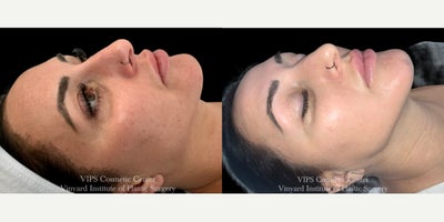 35-44 year old woman treated with DiamondGlow, Skin Rejuvenation, SkinMedica - This patient underwent a Skinmedica DiamondGlow treatment to refresh and brighten her complexion. This three-in-one resurfacing treatment exfoliates the skin, clears congestion, and infuses condition-specific serums for an immediate, healthy glow. Her skin appears smoother, more hydrated, and visibly more radiant with improved clarity and luminosity.