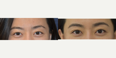 25-34 year old woman treated with Juvederm - Correction of differences seen between the eyes and eyebrows using HA filler to the upper and lower eyelid.