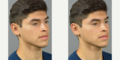 Woman treated with Ear Surgery - Dr. James Marotta sits down to discuss every step of the way with each patient during their consultation. The recovery process is simple, rest, take it easy, and rest some more.