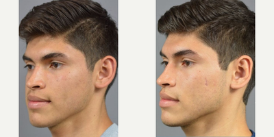 Woman treated with Ear Surgery - Dr. James Marotta sits down to discuss every step of the way with each patient during their consultation. The recovery process is simple, rest, take it easy, and rest some more.