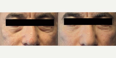 55-64 year old man treated with Juvederm, Volbella, Voluma, Restylane, Restylane Contour - 4D Under Eye Lift - Treatment of dark circles & bags under eyes and cheek restoration with Belotero, Restylane, Volbella and Voluma