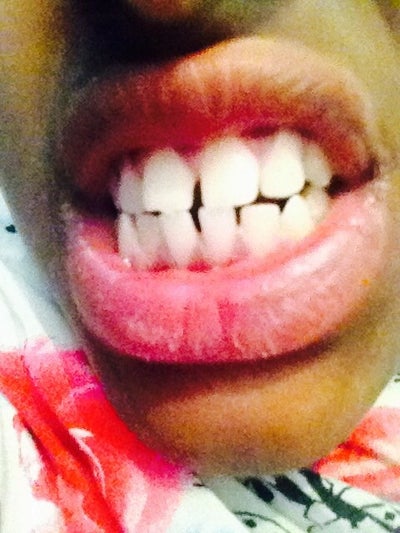 braces take would tx london ago