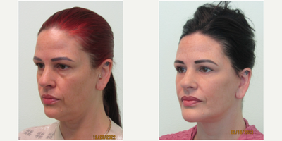 48 year old woman treated with SMAS Facelift, Neck Lift, Chin Implant, & Lower Eyelid Surgery - This woman presented with 2 primary concerns. Her first concern was in regards to her lack of profile and the excess tissue and fullness under her chin. Her second concern was regarding the chronic under eye bags that were persistent since her mid-30's.We decided together to perform a lower facelift and necklift along with placement of a silicone chin implant and a lower blepharoplasty to remove the eye bags. All procedures were performed in our Center under local anesthesia and oral sedation with xanax. No general anesthesia or IV anesthesia was utilized.Her results are significant with major improvement in her profile and facial harmony/balance overall. Her eyebags were successfully removed creating for her a more awake and refreshed appearance.Total procedure time was slightly over 3 hours. Most of her sutures were removed on day 6. She returned to both work and exercise 12 days after her procedures.