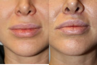 Woman treated with Lip Lift - Woman treated with Lip Lift for improved upper lip aesthetics