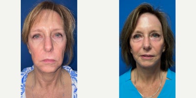 63 year old woman treated with Deep Plane Facelift, Facelift, Facelift Revision, SMAS Facelift, Neck Lift, Eyelid Surgery,Ablati - 63 year old woman 13 months after secondary (revision) deep plane facelift/necklift, secondary upper blepharoplasty (skin only), secondary facial fat grafting, and ablative erbium laser resfurfacing (deep laser peel).
