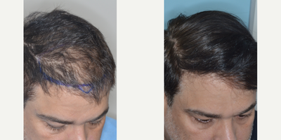 45-54 year old man treated with FUE Hair Transplant - Before and after 1691 FUE hair grafts to help restore density to the frontal area in a male patient with thinning hair
