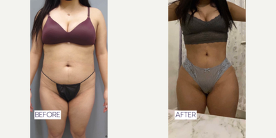 Woman treated with Brazilian Butt Lift - Woman treated with Brazilian Butt Lift through fat transfer to buttocks and hips from Vaser Lipo 360, shown 1.5 years post op.