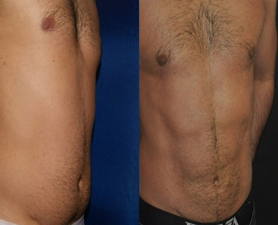 Vaser Liposuction - This patient underwent Vaser Mid Def for the abdomen. Revealing abdominal muscles for a more toned, fit look.