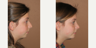 17 or under year old woman treated with Chin Implant - rhinoplasty and chin implant - incision inside of the mouth