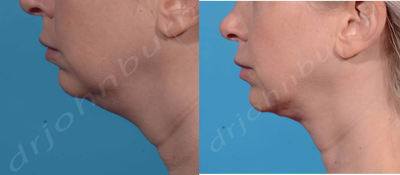 35-44 year old woman treated with Kybella - Kybella: 3 session with 1 vial per session