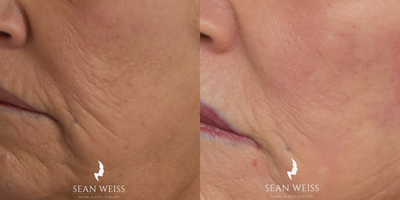 65-74 year old woman treated with CO2 Laser - Fractionated CO2 Laser helps to smooth fine lines and deminish the appearance of deeper wrinkles. It can also help to brighten the appearance of the skin, eliminate sun damage, and build collagen.