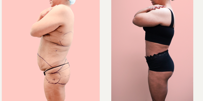 35-44 year old woman treated with Tummy Tuck, Tumescent Liposuction, Vaser Liposuction, Brazilian Butt Lift - This wonderful patient wanted to improve her curves, flatten her abdomen and reshape her torso. She is shown 3 months after 360 liposuction, tummy tuck and brazilian butt lift.