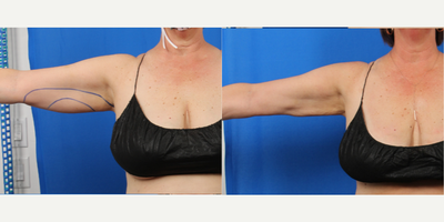 55-64 year old woman treated with Liposuction, Liposculpture, Thermage, Exilis - 55 year old female with liposuction and thermae on same day as surgery, followed by Exilis for additional skin tightening.