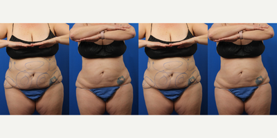55-64 year old woman treated with Liposuction, Liposculpture, Thermage, Exilis - 55 year old female with liposuction and thermae on same day as surgery, followed by Exilis for additional skin tightening.