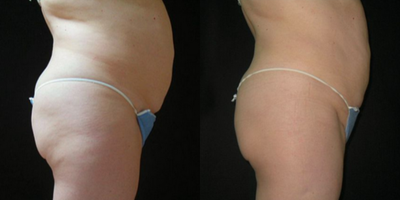 UltraShape - Photos provided courtesy of Syneron & Candela, performed by D. Ad-El, MD