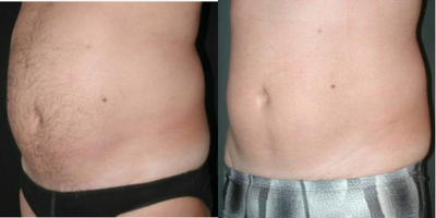 UltraShape - Photos provided courtesy of Syneron & Candela, performed by Benjamin Ascher, MD