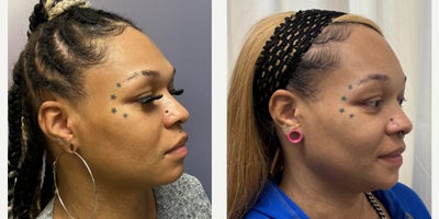 35-44 year old woman treated with Forehead Reduction, Brow Bone Reduction, Brow Lift, Facial Feminization Surgery - This young lady underwent forehead feminization, and chin feminization.