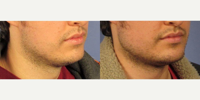 25-34 year old woman treated with Chin Implant - This gentleman in his 20s wanted a more masculine jawline. He had jaw implants placed to his chin and the angle of his jaw. Silicone implants were placed through incisions placed in the mouth. Here he is at 2 month follow up.