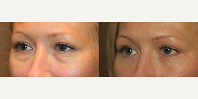 Woman treated with Eyelid Surgery - Woman treated with Eyelid Surgery