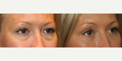 Woman treated with Eyelid Surgery - Woman treated with Eyelid Surgery