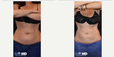 Woman treated with Liposuction - Woman treated with Liposuction