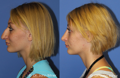 Rhinoplasty -
Rhinoplasty