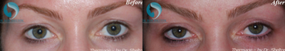 25-34 year old woman treated with Thermage to help lift upper eyelid sagging - Upper eyelids start to sag in our 30s and prevent problems with Botox treatment of the forehead as that can increase the temporary lowering of hooding, or extra upper eyelid skin. This skin can be tightened as shown here with Thermage, one treatment.
