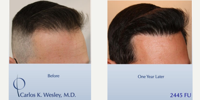 Patient treated with FUE Hair Transplant, Hair Loss Treatment, Hair Transplant - This 43-year-old man underwent a follicular unit extraction (FUE) session with Dr. Carlos K. Wesley in which a total of 2445 grafts were placed.